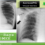 Chest X ray visuals for PGMEEs