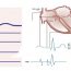 HIS Bundle electrocardiogram